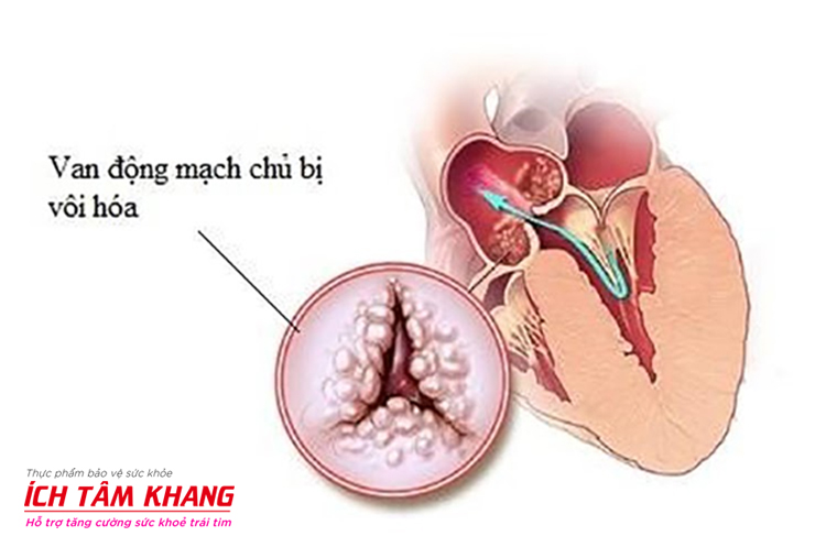 Nguyên nhân gây ra hẹp van động mạch chủ là tình trạng van bị vôi hóa
